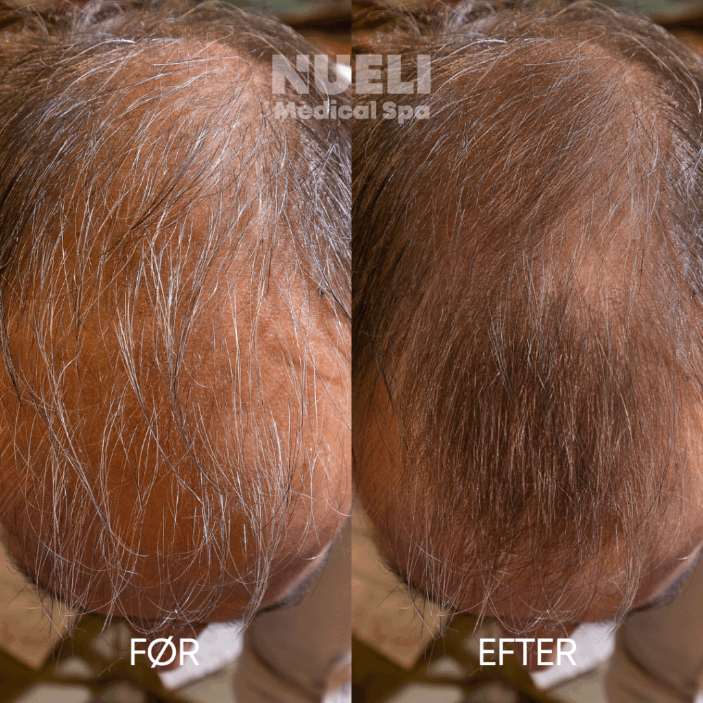 Hårtab PRF behandling